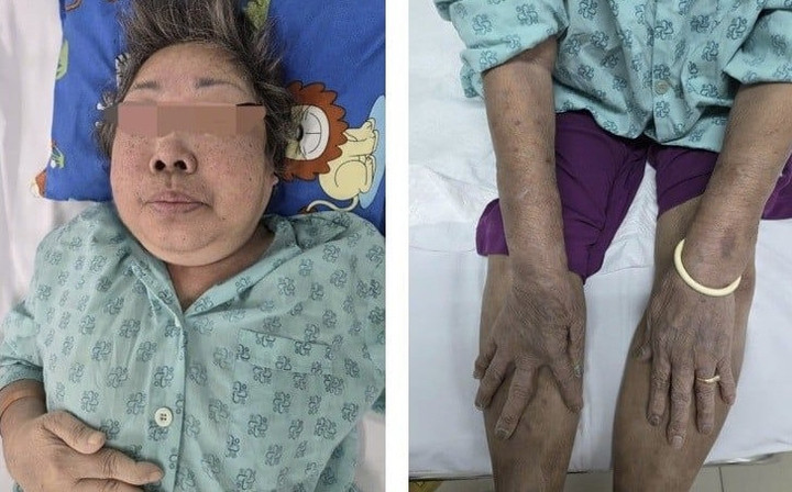 Một bệnh nhân mắc hội chứng Cushing. (Ảnh minh họa: Bệnh viện cung cấp)