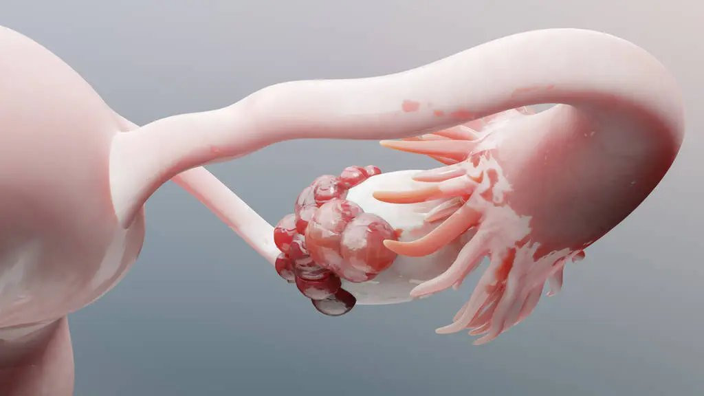 Người phụ nữ 58 tuổi phát hiện ung thư buồng trứng từ dấu hiệu nhiều chị em Việt bỏ qua - Ảnh 3.