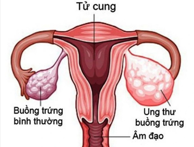 Người phụ nữ 58 tuổi phát hiện ung thư buồng trứng từ dấu hiệu nhiều chị em Việt bỏ qua - Ảnh 2.