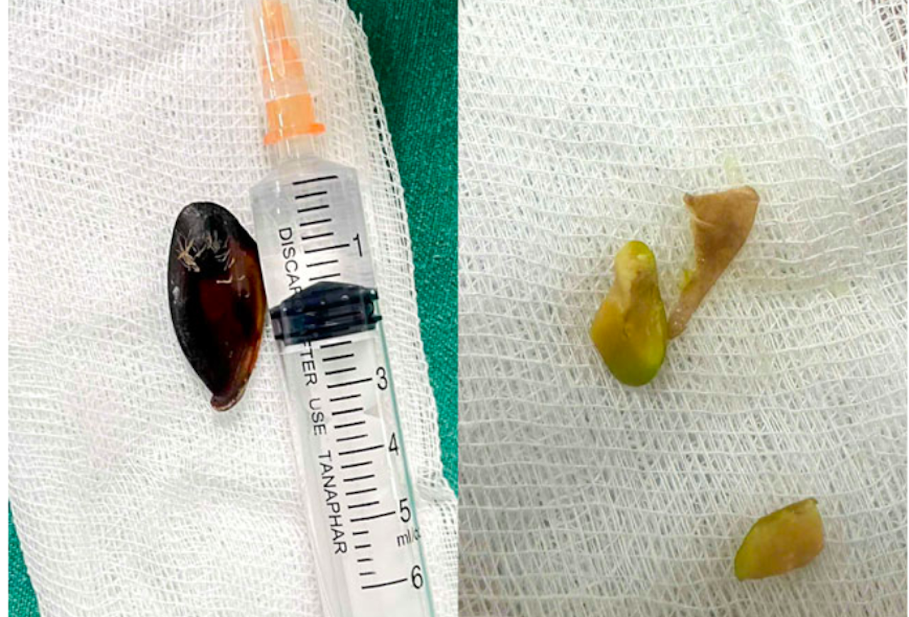 Dị vật mắc kẹt trong đường thở của trẻ suốt 13 tháng插图 Ảnh chụp Màn hình 2026 04 13 lúc 20.05.58.png