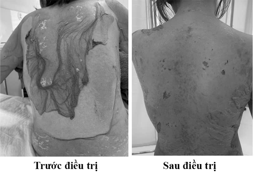 Người phụ nữ Hải Phòng bị tróc da như 'cua lột', lý do tự mua thuốc dị ứng插图 Wz7751871516076_5f4966f022282f9ba19601c47b0ba8b1.jpg