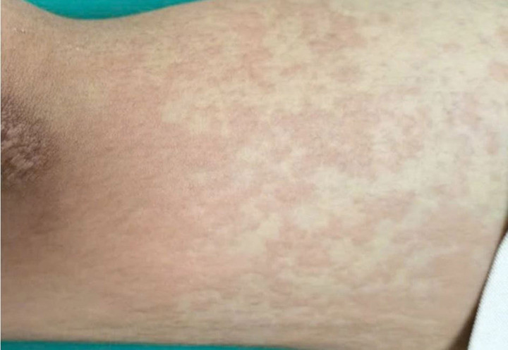 Nam sinh nổi ban, sưng môi, tê lưỡi và được chẩn đoán sốc phản vệ sau khi ăn ve sầu (Ảnh: BVCC).