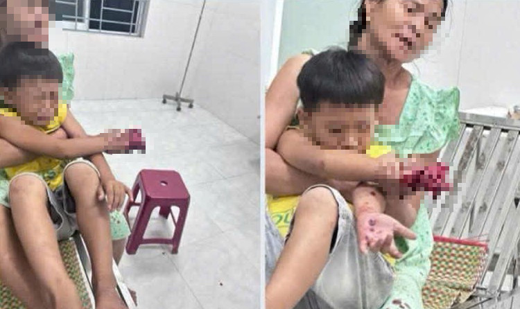 Cháu bé bị dập bàn tay nghi do điện thoại nổ lúc sạc pin - Ảnh 1.