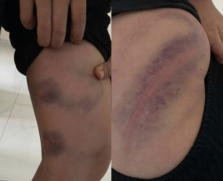 Hình ảnh vùng chân và mông của cháu Hiếu với nhiều vết thâm tím.