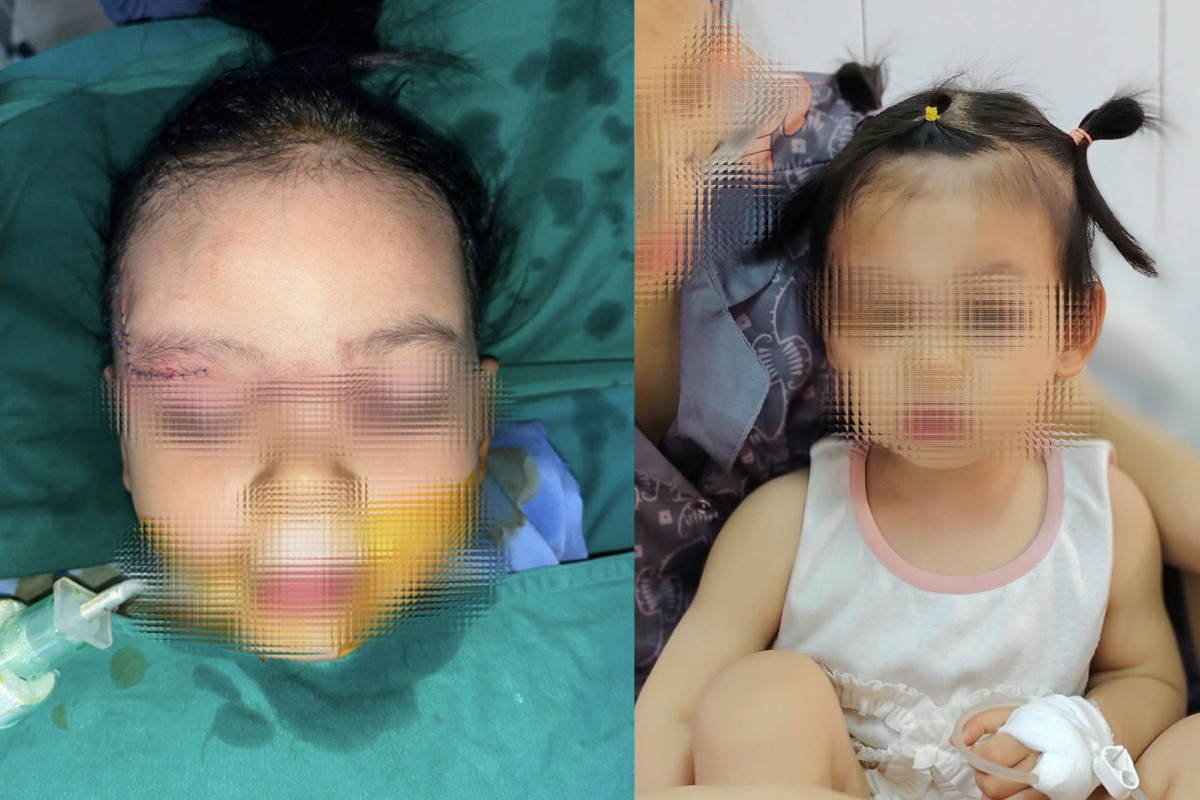 Bé gái 22 tháng tuổi bị chó cắn tổn thương nghiêm trọng khuôn mặt插图 be gai 22 thang tuoi bi cho can ton thuong nghiem trong khuon mat hinh anh 1