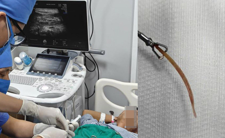 Đau bụng suốt 10 ngày, bất ngờ vì 'thủ phạm' là tăm nhọn đâm thủng đại tràng