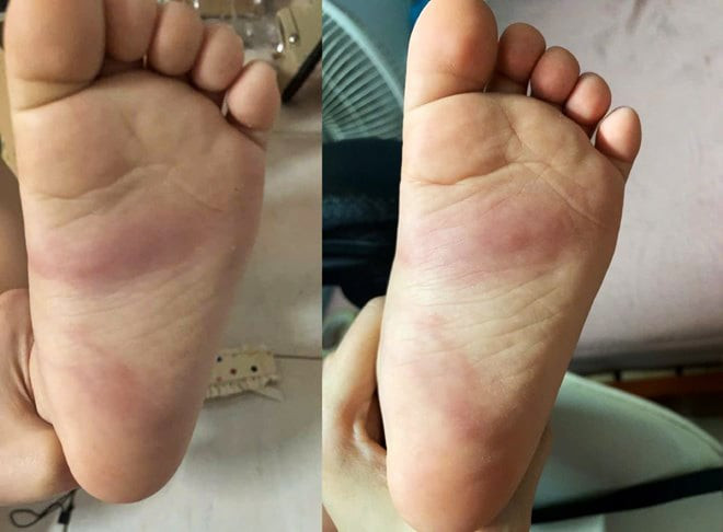 Lòng bàn chân cháu bé hằn vết bầm tím nghi do bị giáo viên bạo hành. (Ảnh: Gia đình cung cấp)