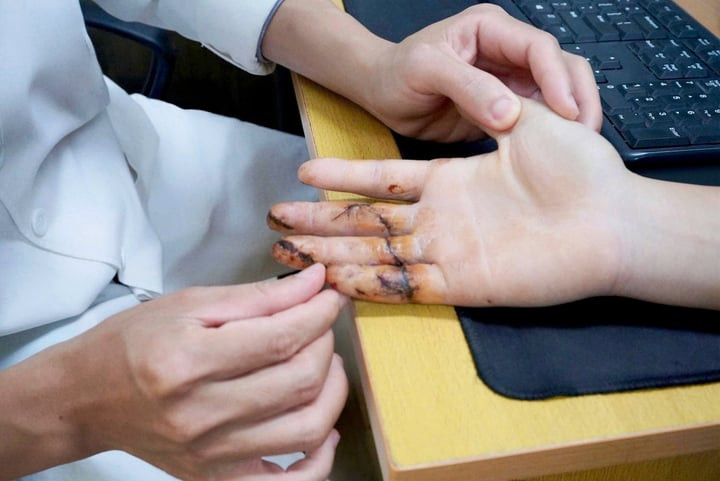 Ngón tay được nối thành công, phục hồi tốt. (Ảnh: BVCC)