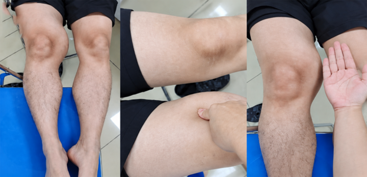 Phát hiện ung thư mô mềm từ khối u bất thường 12cm (Ảnh: BVCC)